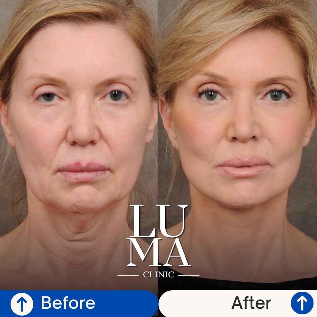 Estetik İşlem - Yüz Yenileme