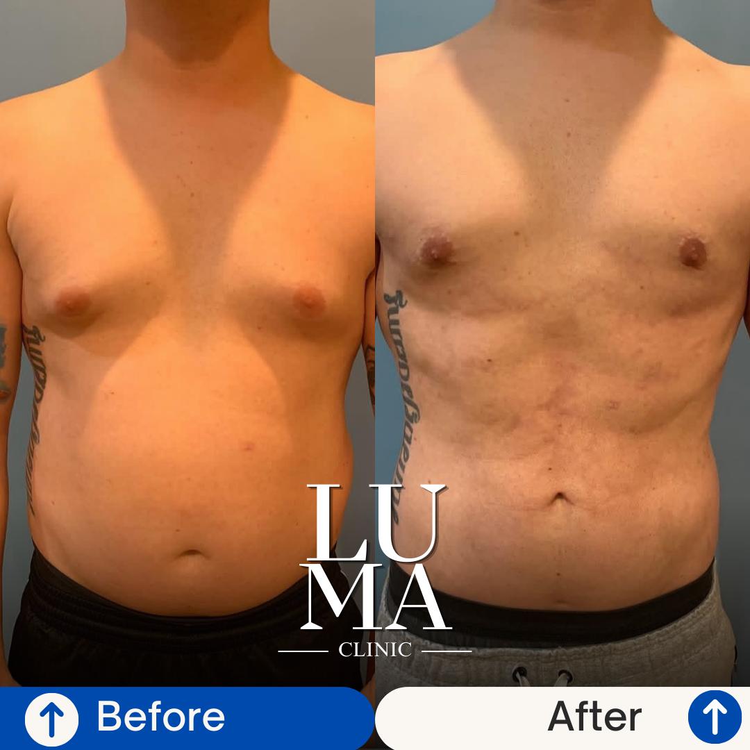 Estetik İşlem - Liposuction