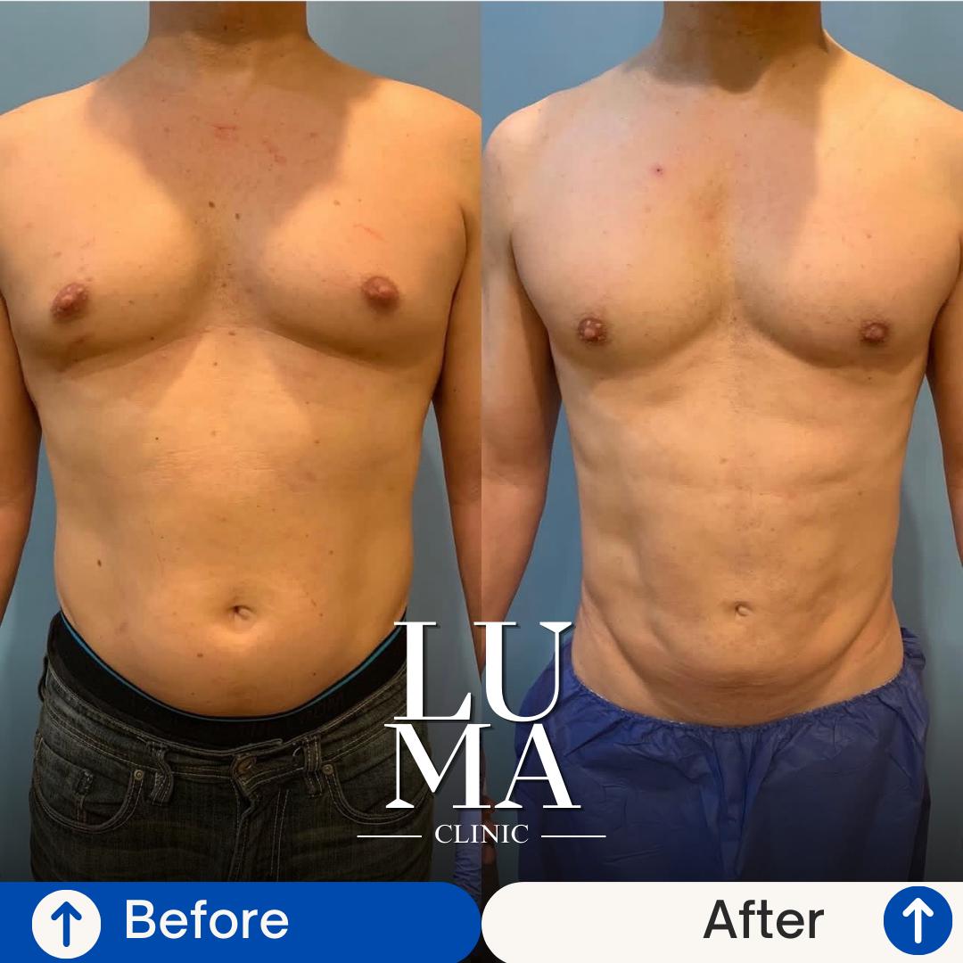 Estetik İşlem - Vücut Şekillendirme