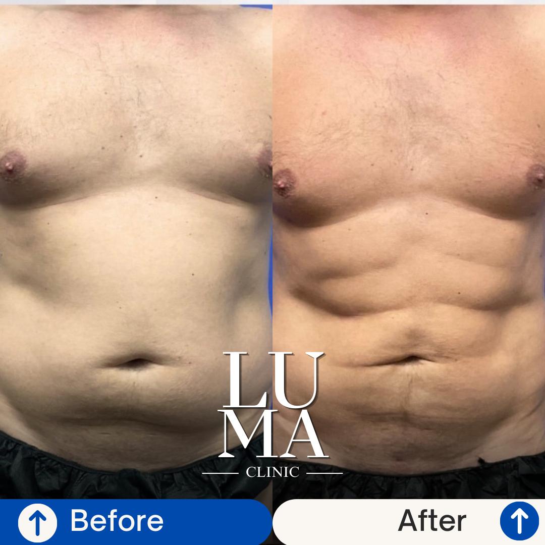 Estetik İşlem - Karın Germe