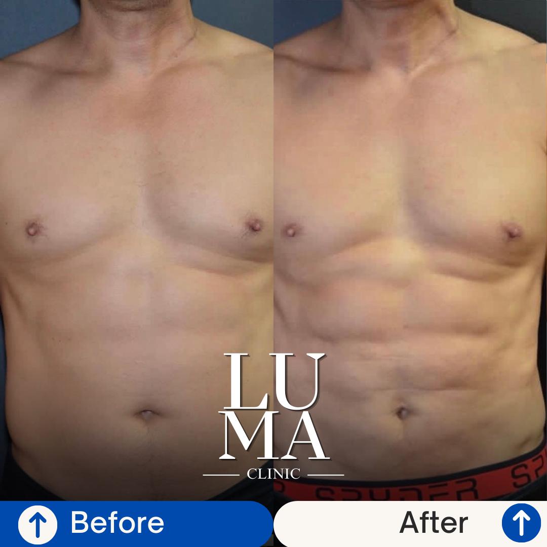 Estetik İşlem - Vücut Konturlaması