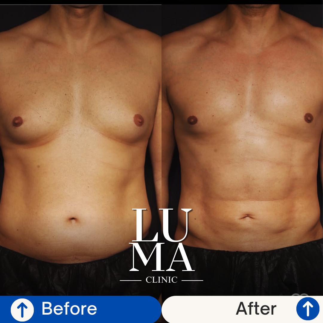 Estetik İşlem - Kas Tanımı