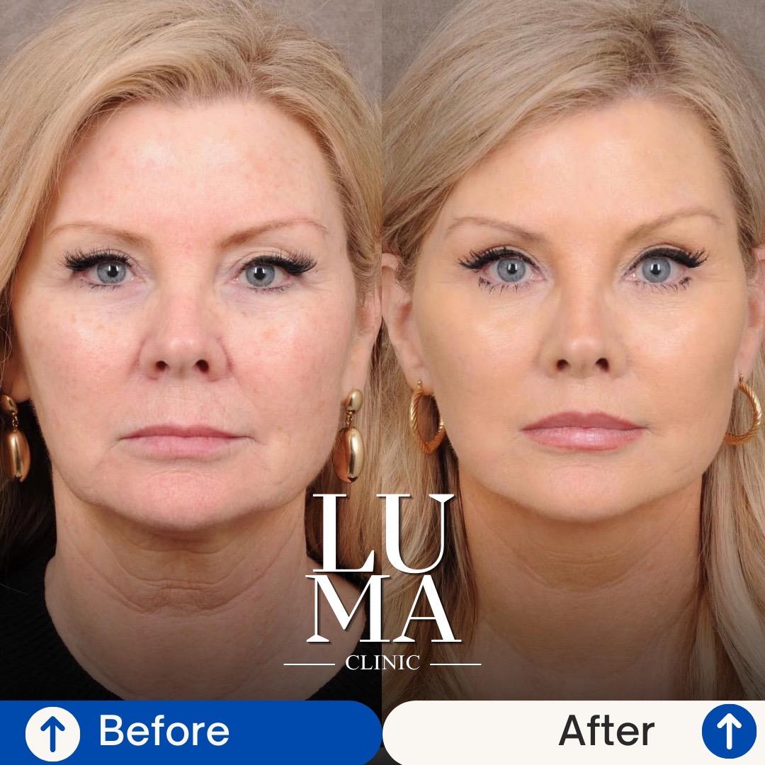 Estetik İşlem - Cilt Yenileme